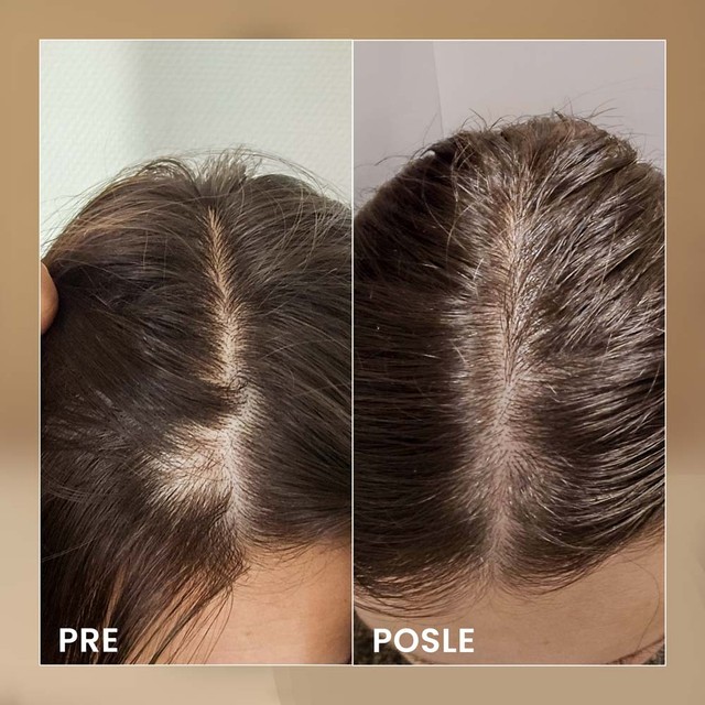 BIOELIXIR-SCALP----prije-posle---SRB