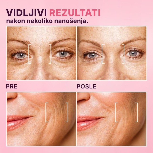 BOTOX---PRIJE-POSLIJE-srb